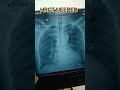 HRCT NEEDED Parenchymal Lesion Clearly Seen 2026 