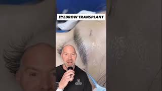 Eyebrow Transplants Require Precision  #shorts