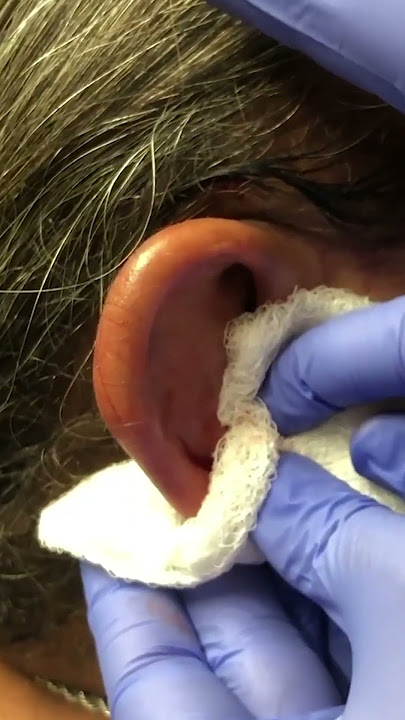 Auricular Hematoma Incision and Drainage with Bolster Compression Dressing