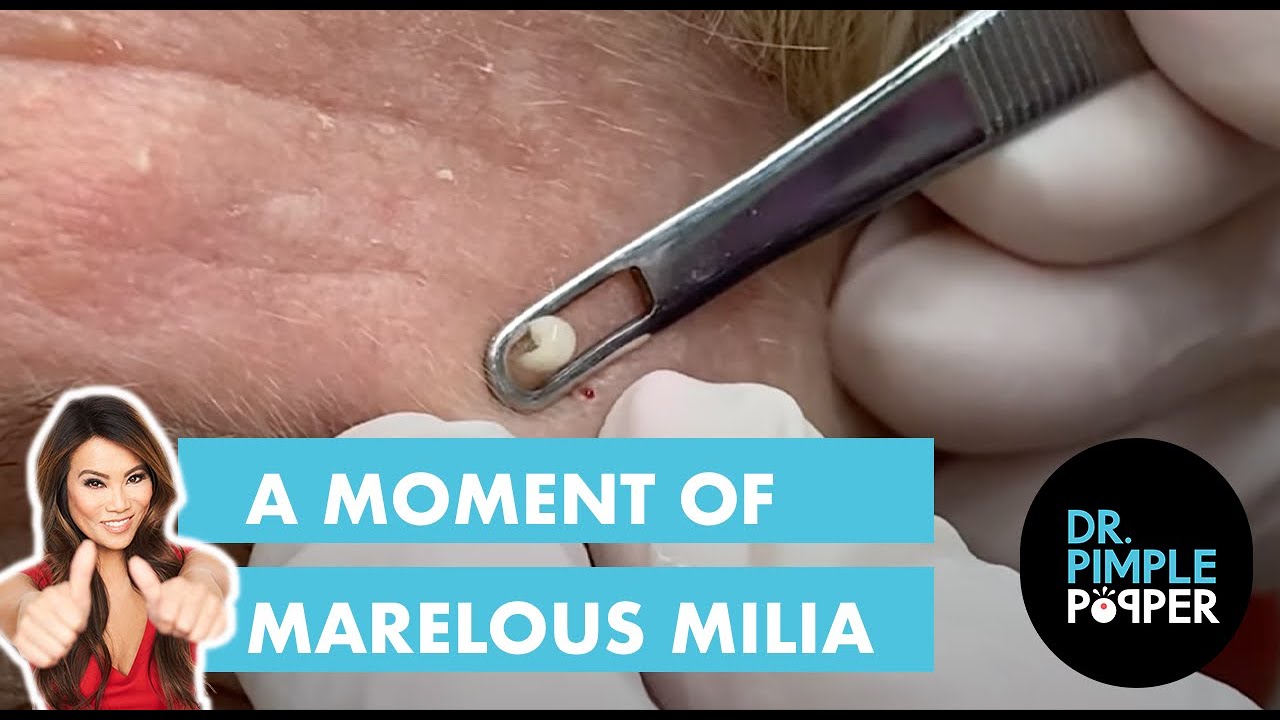 A Moment of Marvelous Milia