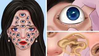 ASMR Remove parasitic eyes \& Large pustules on face | Acne Deep Cleaning Animation