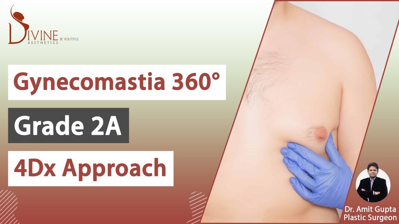 Gynecomastia 360° Grade 2A 4Dx Approach | Dr. Amit Gupta Plastic ...