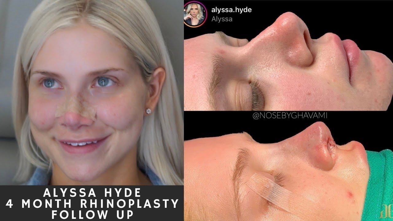 4 Months Post Very Complex Primary Rhinoplasty With @Charles \U0026 Alyssa Forever  ??✨