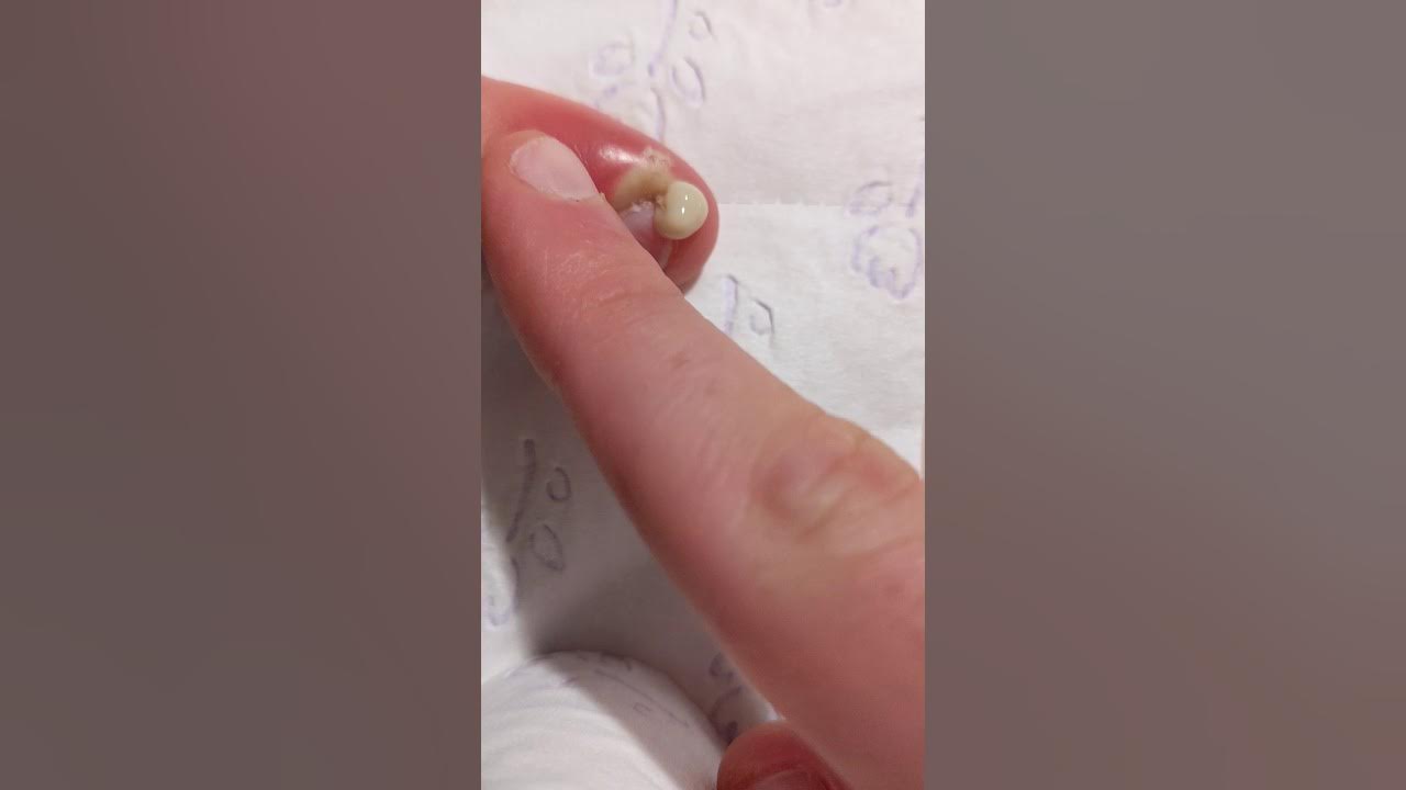 draining-pus-from-ingrown-fingernail-youtube
