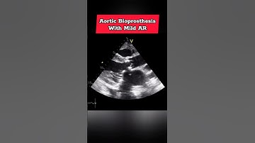 Aortic Bioprosthesis with Mild AR - Echocardiography for Beginners #Echo #heart #echocardiology
