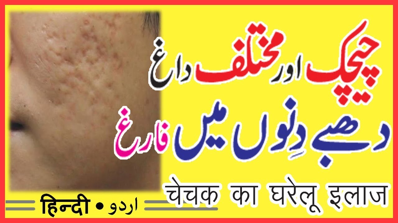 how to remove chicken pox marks at home | by sanam video editing software free