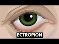 Ectropion: Causes, Symptoms, Complications And Treatment.