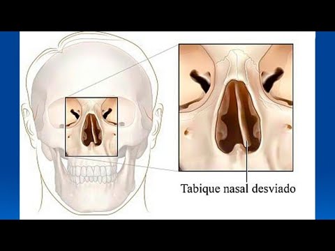 Vídeo: ¿Por Qué Es Peligrosa La Curvatura Del Tabique Nasal?