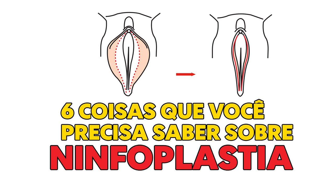 NINFOPLASTIA - CIRURGIA ÍNTIMA 6 DICAS IMPORTANTES - YouTube