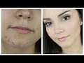 MAQUILLAJE PARA PIEL CON ACNE + PLATICA