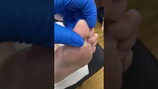 Ever Seen A Big Toe Callus Removal? Tune In To See Aussie Podiatrist In Action!