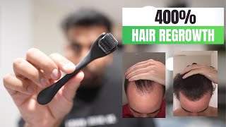 Microneedling For Hair Loss Explained: Double Your Hair Growth!