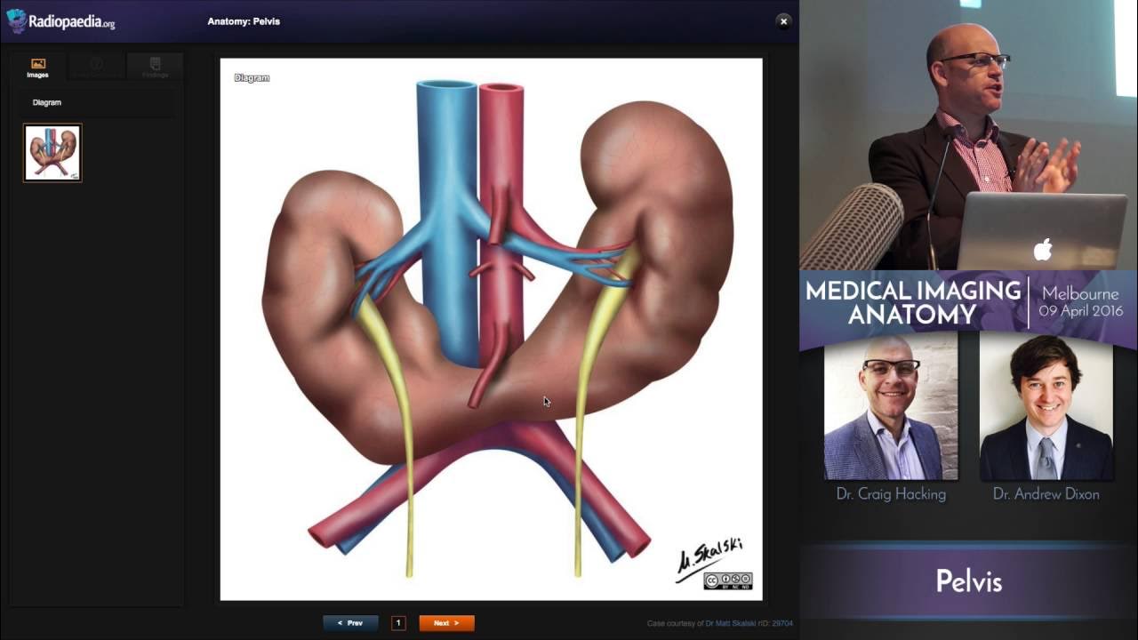 Horseshoe Kidney Medical Imaging Anatomy Course YouTube