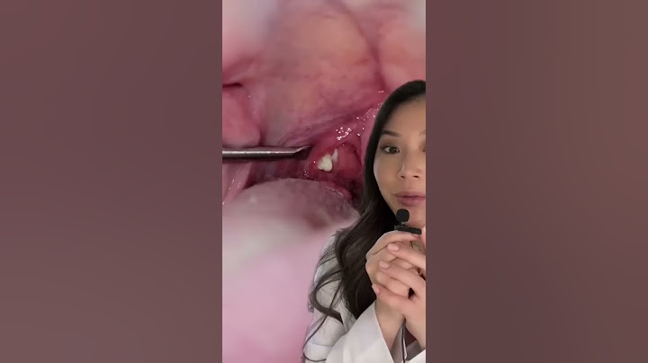 WOW! The most graceful tonsil stone extraction ever! #tonsilstones