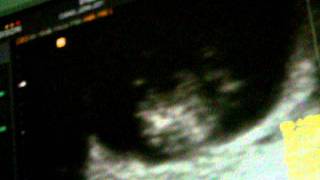 ultrasound at 11 weeks.AVI