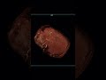 MRAngiography with Cinematic Rendering of Intracranial Arterial circulation.