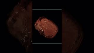 MRAngiography with Cinematic Rendering of Intracranial Arterial circulation.
