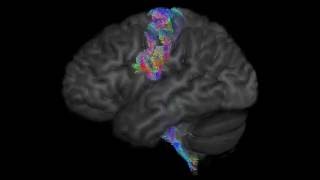 Corticospinal Tract