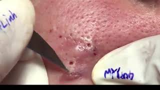 How to remove whiteheads and blackheads (Part 99) - DARINANA Resimi