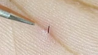 Splinter Removal From My Palm |. Removed Like A Pro | #drtusarofficial by Dr Tusar Official 11,310 views 4 years ago 1 minute, 14 seconds