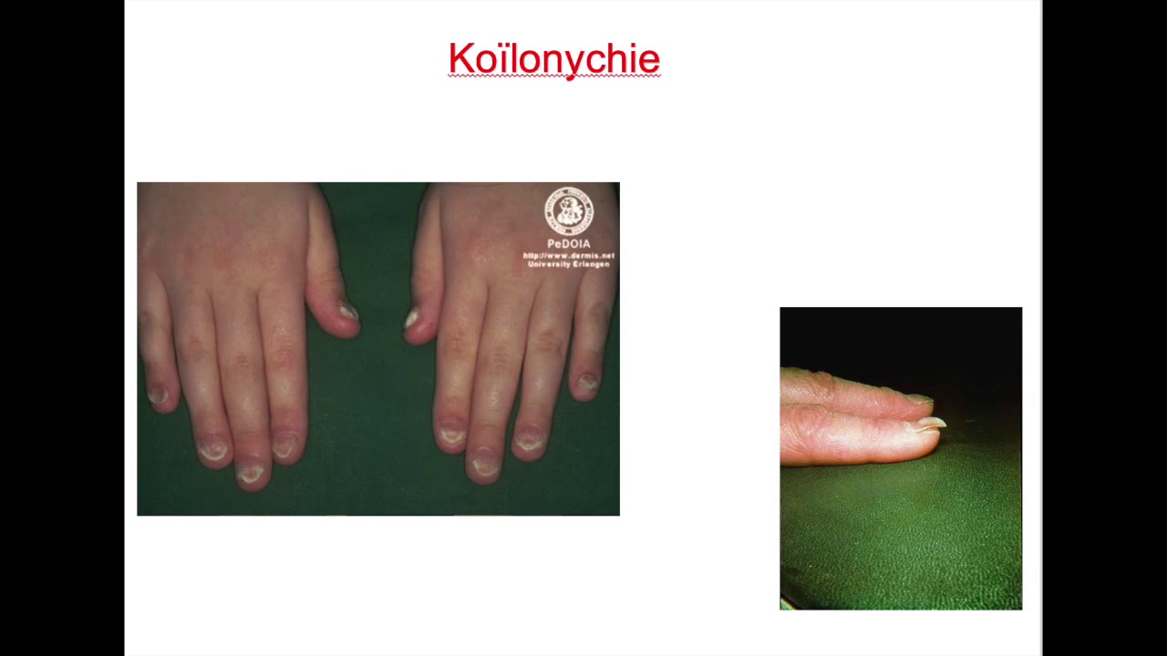 FMPM MOOCs - Hémochromatose- Pr. Z. Samlani