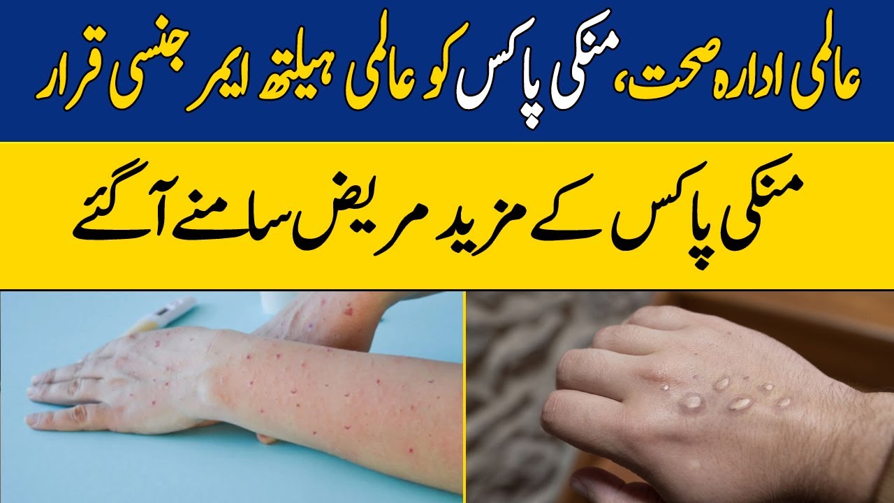 Monkeypox Health Emergency Imposed In Pakistan | Breaking Dawn News ...