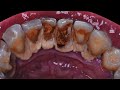 36 yo. Male&#39;s Teeth | TARTAR REMOVAL | Scaling | Dentist | Dokter Gigi Tri Putra