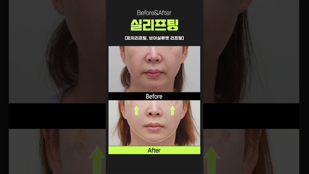 [Виверс Гоо сайхны мэс заслын эмнэлэг] Утасны өргөлтөөр V-лайн эрүүний уян хатан чанарыг дээшлүүлнэ ✨