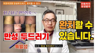 지긋지긋 재발하는 만성 특발성 두드러기? 완치할 수 있습니다. [생생별곡]