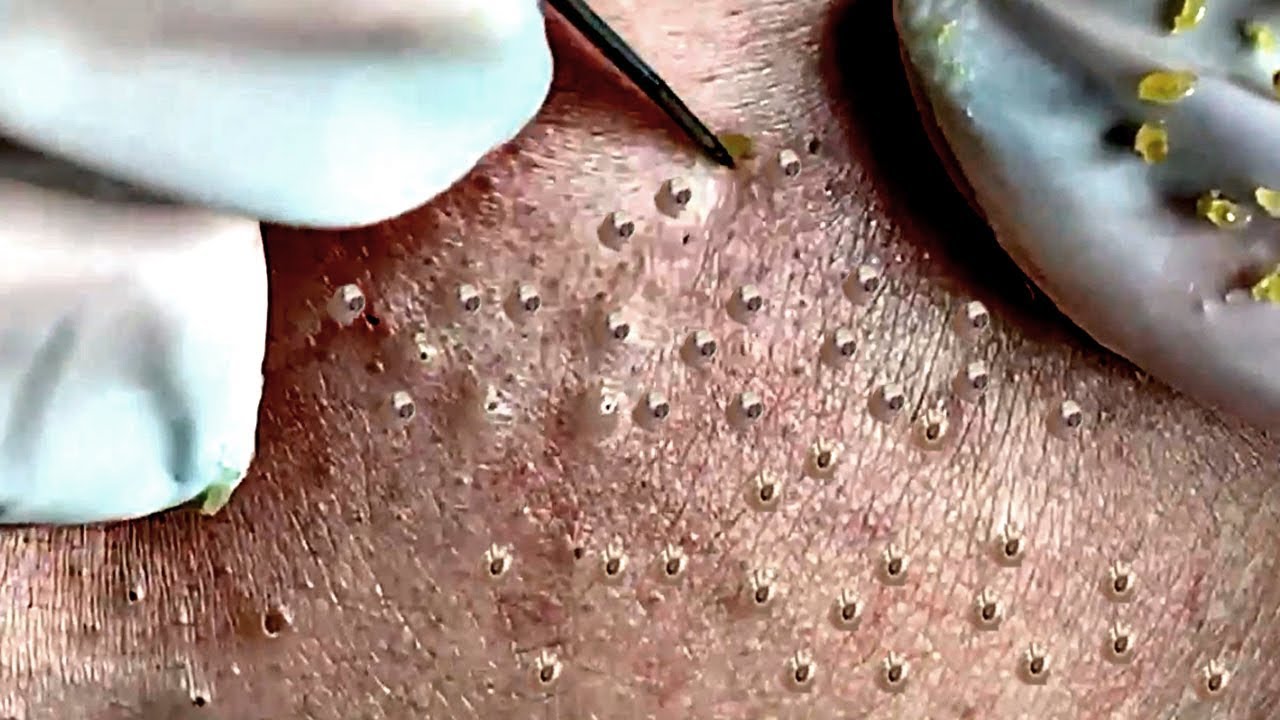 acne treatment for hung p1