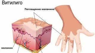 Сафедшавии пуст, Витилиго, тагиребии ранги пуст.