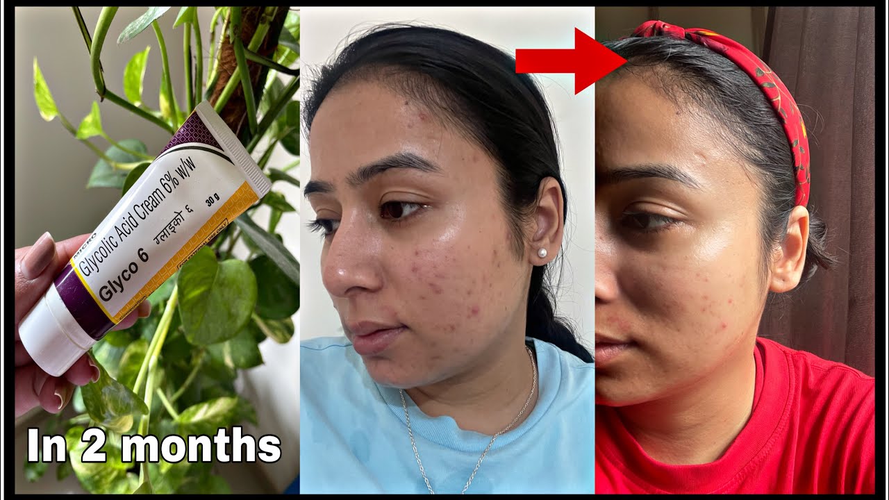 Glycolic Acid Cream| My Experience | Glycolic A | Glycolic Acid 