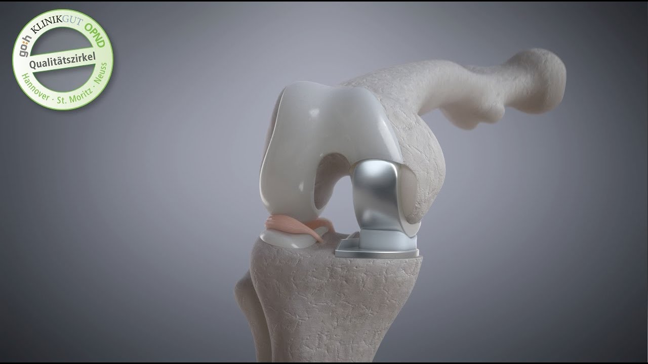 Update New Mediale Arthrose am Knie: Teilprothese Oxford Schlitten