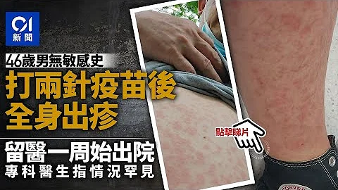 【新冠疫苗】46岁男无敏感史　打两针后全身出疹　专科医生指较罕有｜01新闻 - 天天要闻