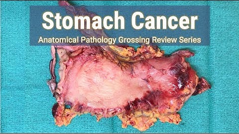 Stomach Cancer | Anatomical Pathology Grossing Review Series