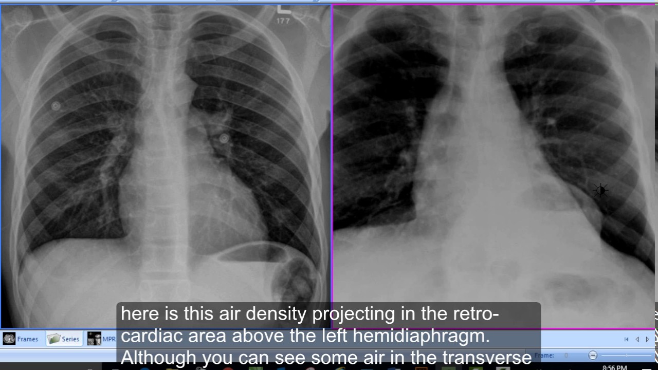 Chest X Ray Hiatus Hernia Youtube