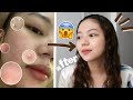 HOW I CLEARED MY SKIN? + GIVEAWAY (150 WINNERS) | Philippines