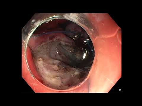 Closure of a large mucosal defect with endoloop and clips.