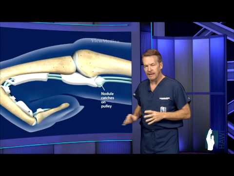 Video: Trigger Finger Surgery: Herstel, Procedure En Meer