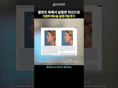 이중턱재수술 후기, 어떻게 달라졌을까?