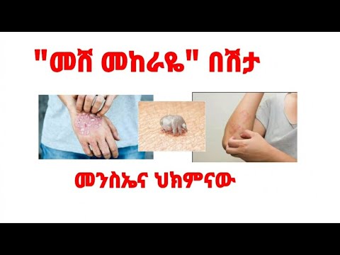 ቪዲዮ: Ileus እንዴት ይከሰታል?