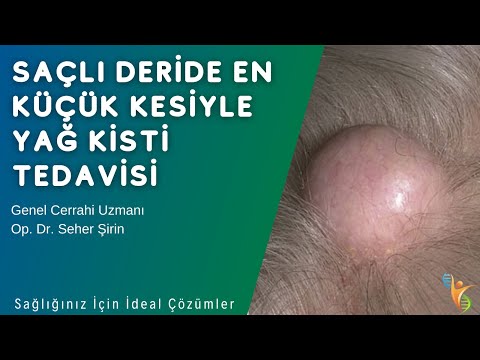 Saçlı Deride En Küçük Kesiyle Yağ Kisti Tedavisi - Op. Dr. Seher ŞİRİN - IDEA Klinik