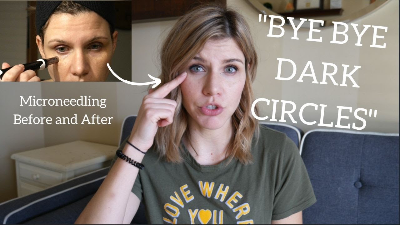 eyes dark circles before after