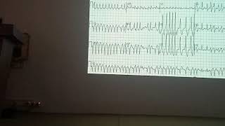 TOACS 23, ECG