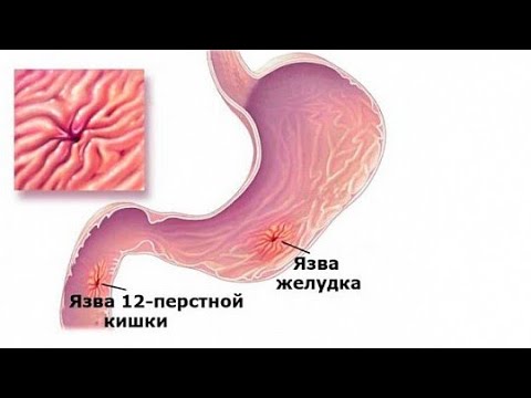 Язвенная болезнь желудка и двенадцатиперстной кишки