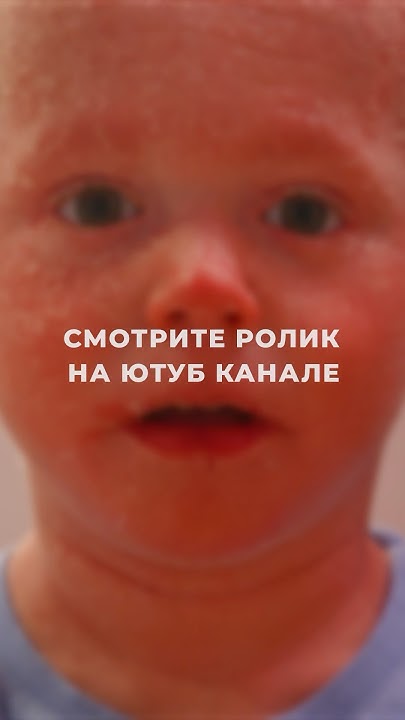 Ихтиоз - YouTube