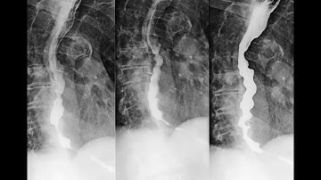 Diffuse oesophageal spasm before and after POEM
