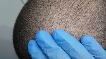 SMP scalp Micro Pigmentation density by El Truchan @ Scalp Micro Definition