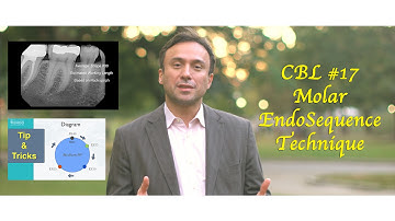 CBL #17 Molar with the EndoSequence Technique