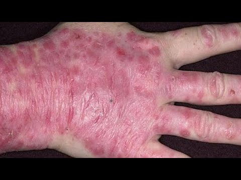 أنواع الصدفية